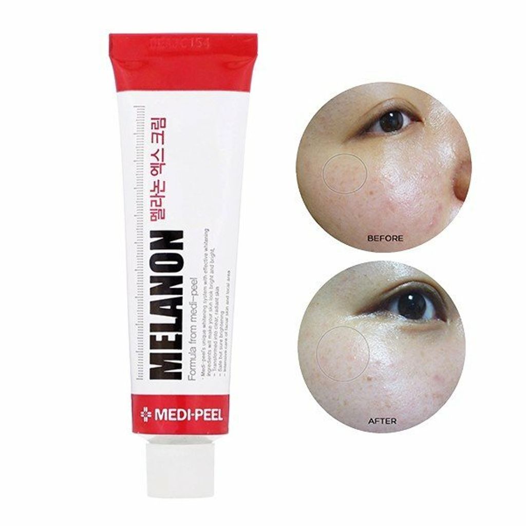 melasma
melanon
creme clareador
clarear melasma
CLAREADOR MANCHAS
acne